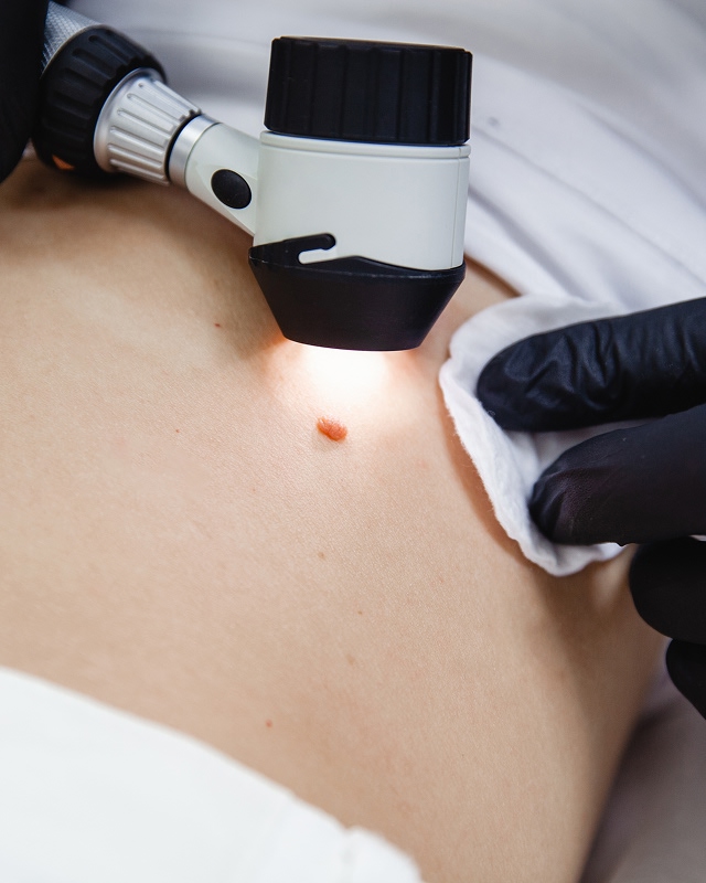 Skin Cancer